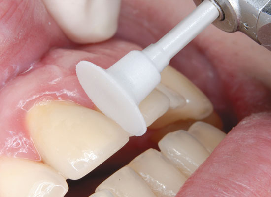 OneGloss PS IC Clinical pic