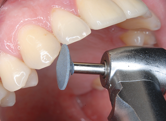 CeraMaster<sup>®</sup> Coarse HP